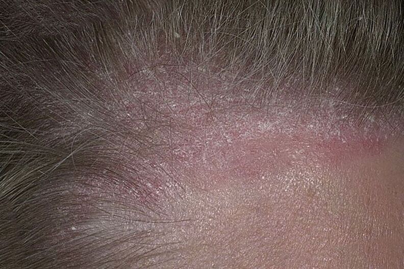 How is psoriasis of the scalp