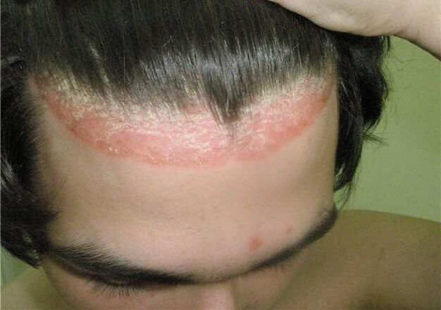 psoriasis crown on the head