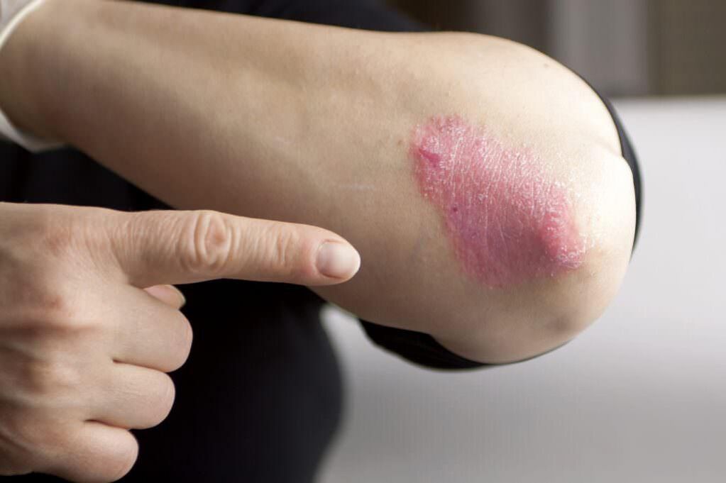 Manifestations of the initial stage of elbow psoriasis. 