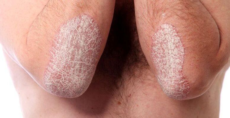 The area of ​​the elbow joints affected by psoriasis. 