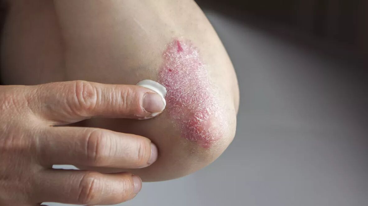 Psoriatic plaques on the elbow treated with medicated cream. 