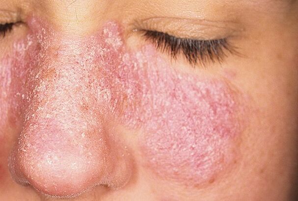 Progressive stage of psoriasis on the skin of the face. 