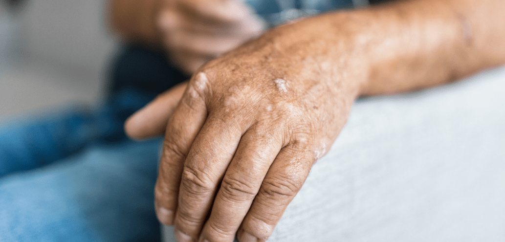 Psoriasis on the skin of the hand. 