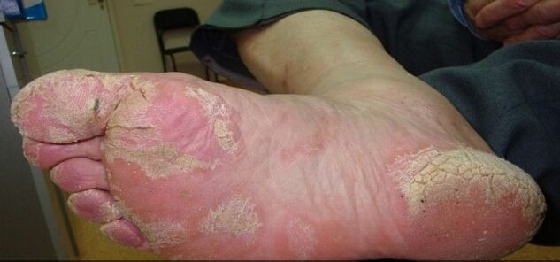 Leg psoriasis