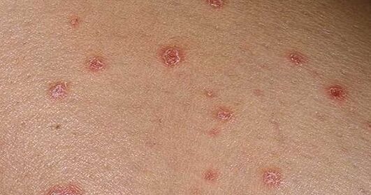 Psoriatic plates