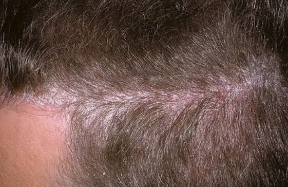 Psoriasis in the head