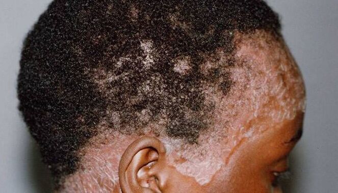 Psoriasis in the head