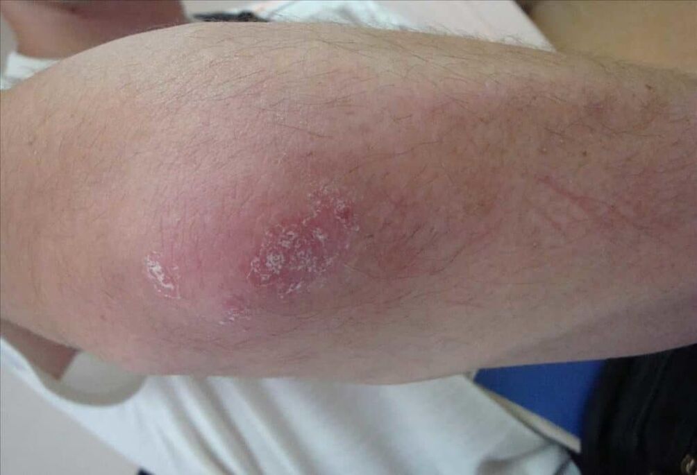 How psoriasis looks