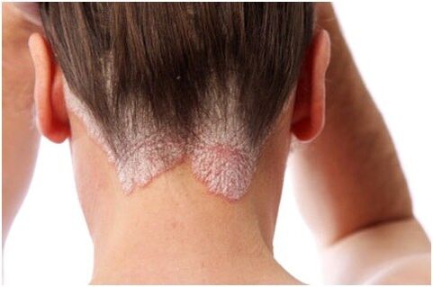 Hair psoriasis