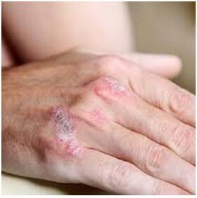 Psoriasis in the brush