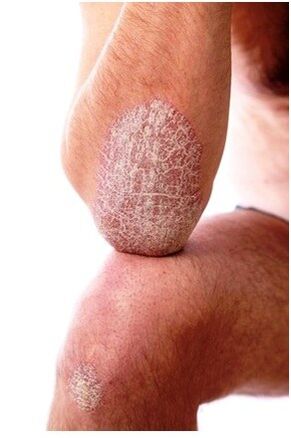 Psoriasis in the elbow