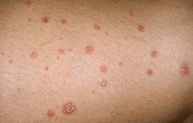 Psoriatic plates