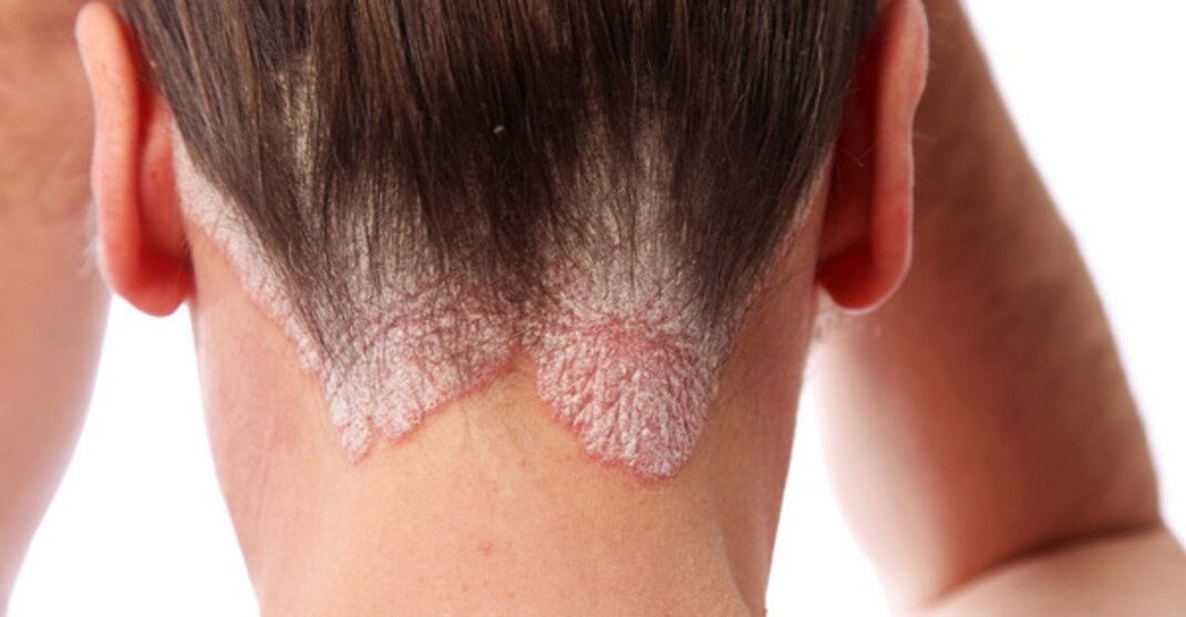 Psoriasis on the head of the girls
