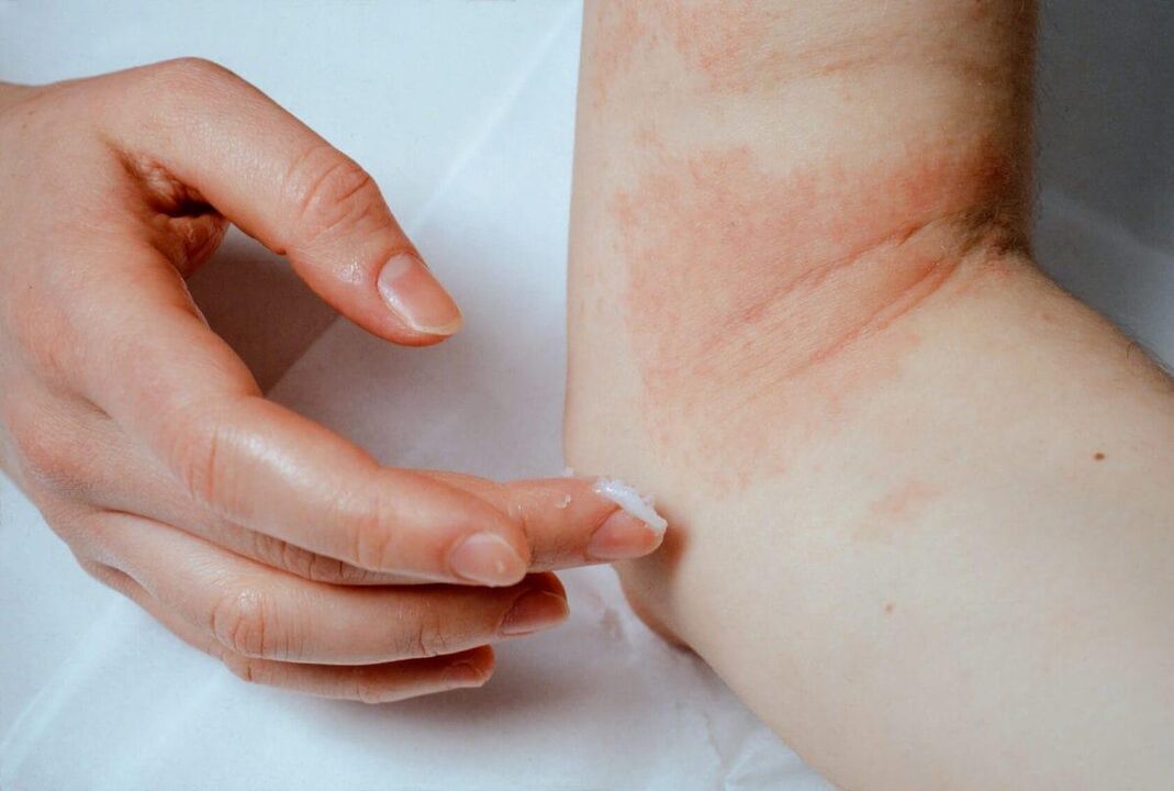 Psoriasis treatment