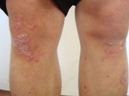 The causes of psoriasis