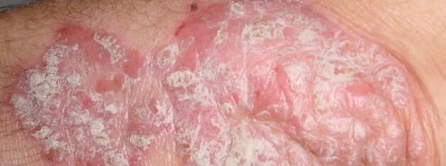 Mesnichered psoriasis