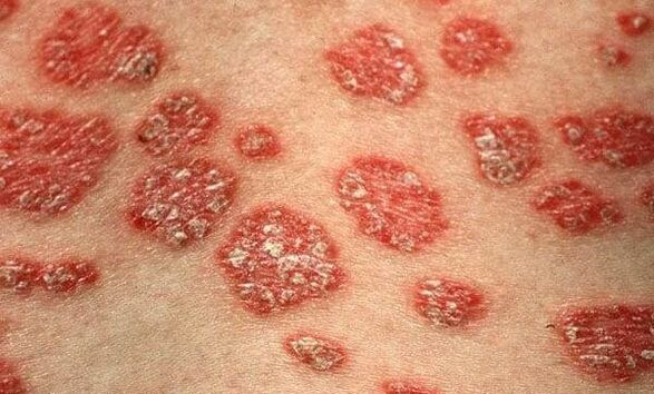Psoriasis forms