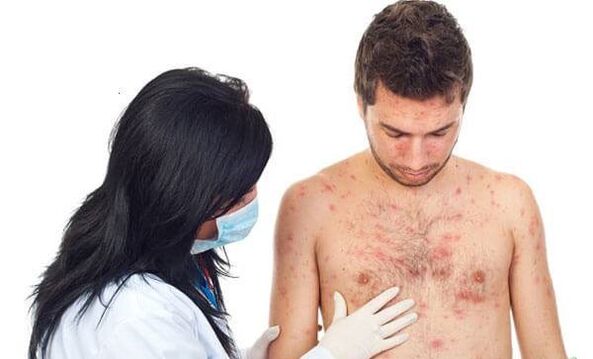 Psoriasis photo
