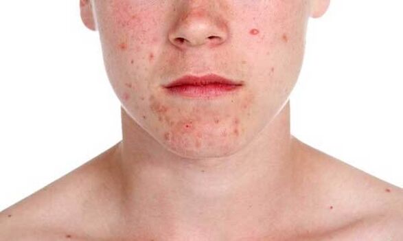 Psoriasis symptoms