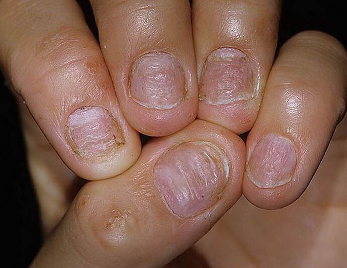 Nail psoriasis