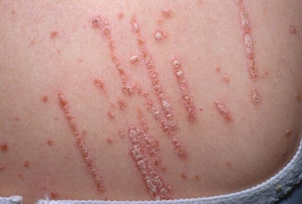 Psoriasis in the body