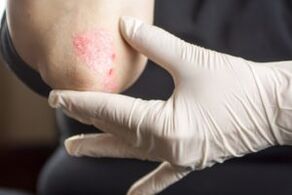 Psoriasis in the elbow