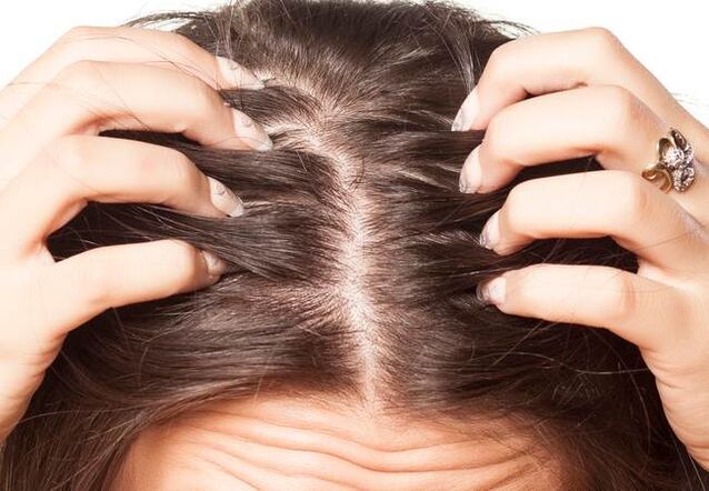 Psoriasis in the head