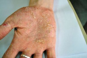 Psoriasis in the palm of your hand