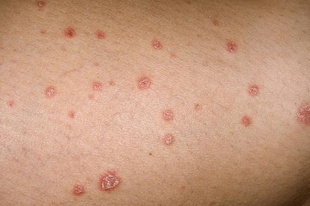 Psoriatic plaques