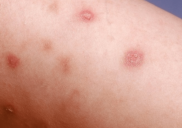 Initial stage of psoriasis.