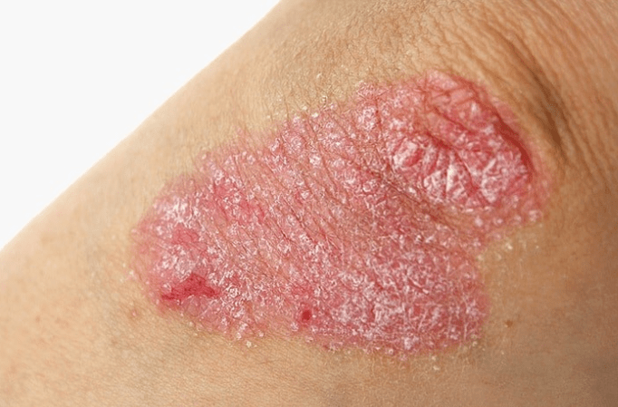 Progressive stage of psoriasis.