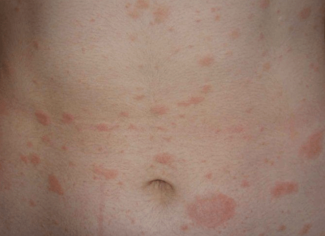 Regressive stage of psoriasis.