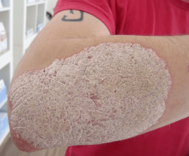 Stationary stage of psoriasis.