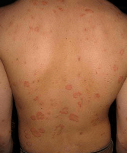 Plaque psoriasis