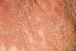 pustular psoriasis