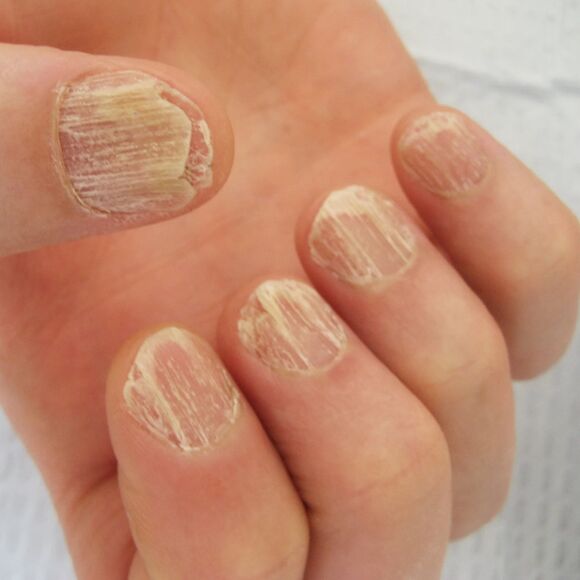 Nail damage due to psoriasis