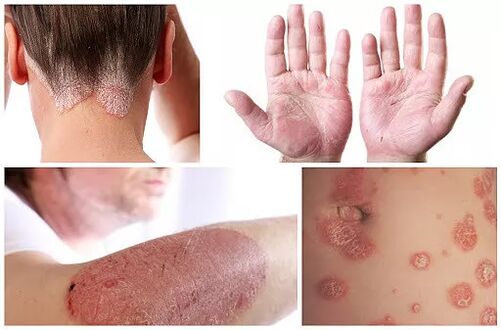 Manifestations of psoriasis in different parts of the body.
