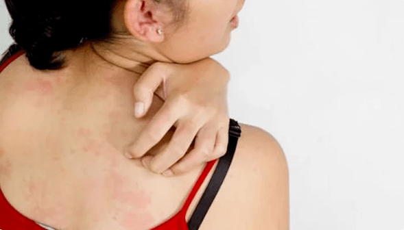 psoriasis