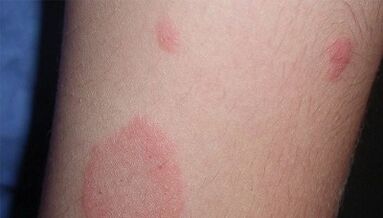How does the initial stage of psoriasis manifest