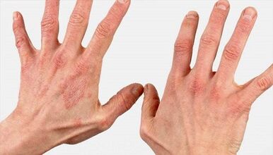 What is the initial stage of psoriasis like