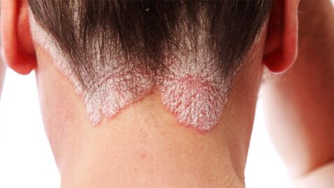 Psoriatic plaques on the scalp.