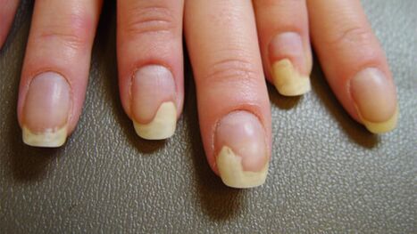 White spots on nails due to psoriasis.