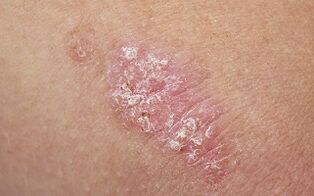 causes of psoriasis