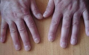 psoriasis symptoms in the initial stage