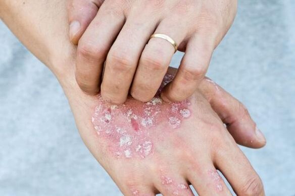 Characteristic symptoms of psoriasis in the hands.