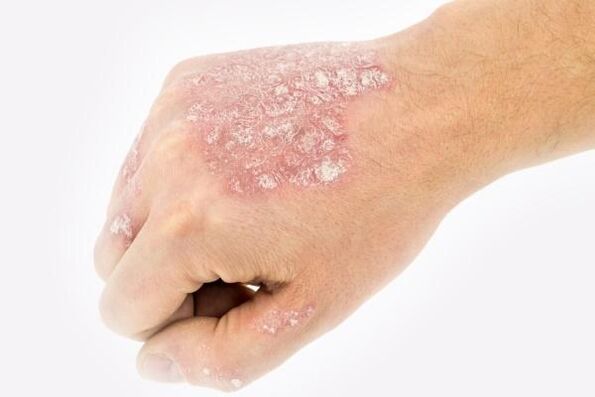 Mechanism of development of psoriasis in the hands.