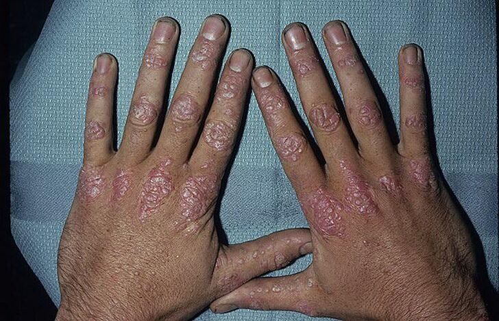 Reasons for the development of psoriasis on the hands.