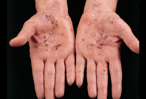 What does psoriasis look like on the palms of the hands