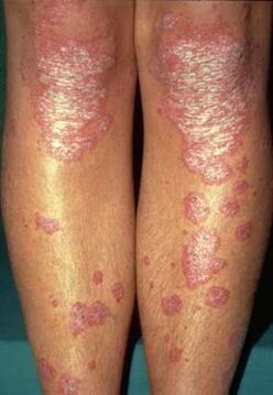 Manifestations of psoriasis on the legs. 