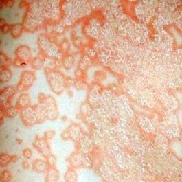 Psoriatic plaques on the body. 